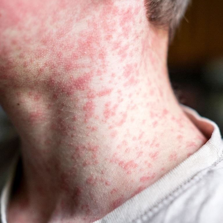 Child's neck with measles.