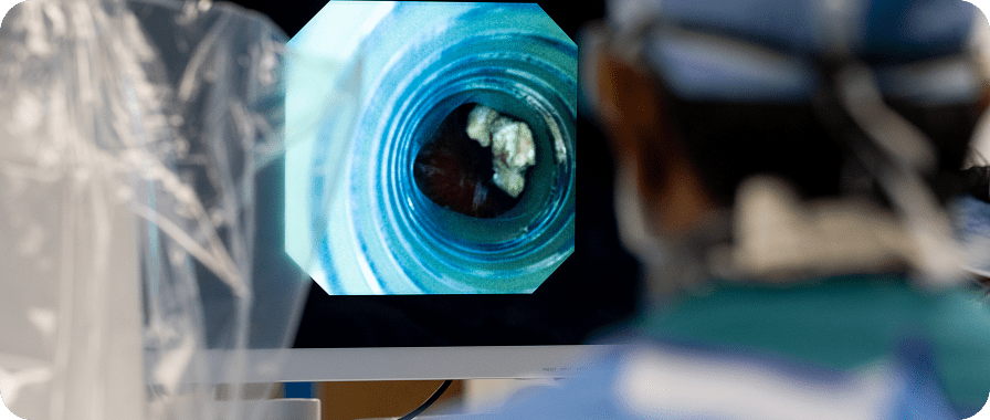 Image of kidney stone during procedure.